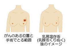 公式 乳房の手術 乳腺外科 乳がん専門 大阪府箕面市 相原病院ブレストセンター