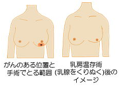 乳がん 手術