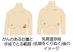 手術 乳がん