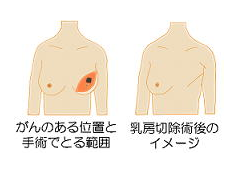 公式 乳房の手術 乳腺外科 乳がん専門 大阪府箕面市 相原病院ブレストセンター