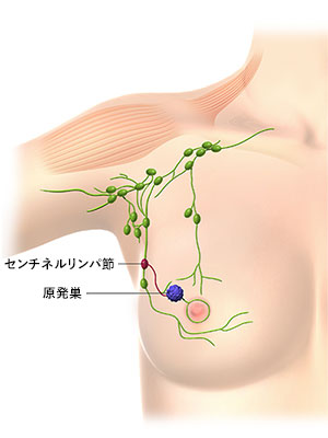 節 転移 余命 乳癌 リンパ