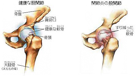 不全 難病 臼 蓋 形成